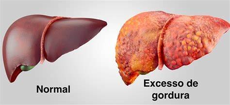 Nutri Simone Prestes: Os riscos da gordura no fígado 1 figado 2 - Acontece Gramado